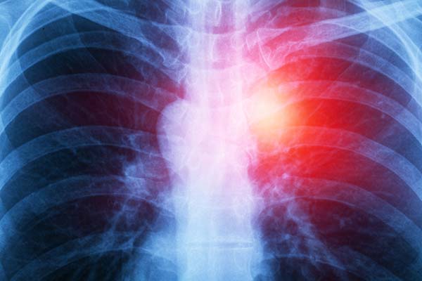mesothelioma