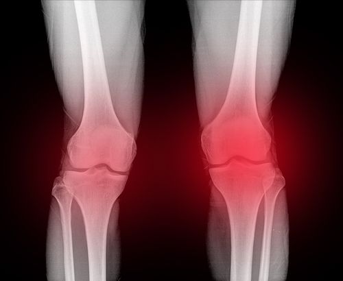 X-Ray Showing Exactech Knee Replacement